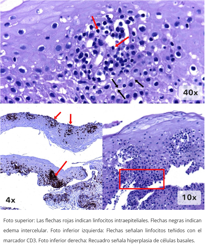 Esofagitis linfocítica - Inmunohistoquímica CD3