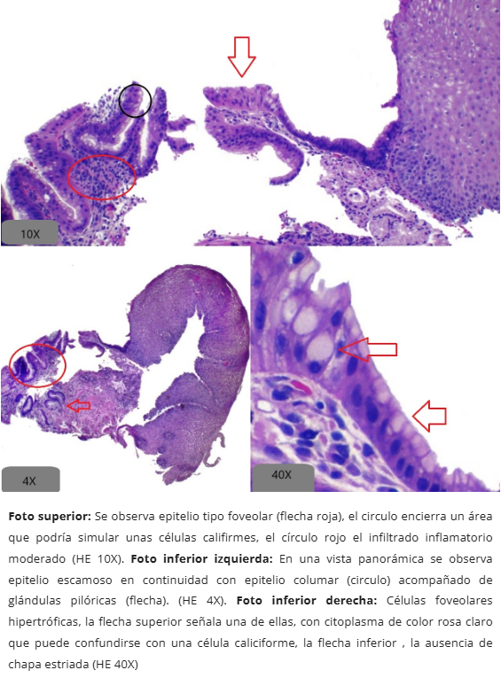 Metaplasia Columnar sin Caliciformes