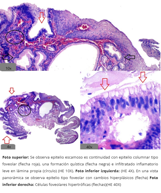 Metaplasia Columnar sin Caliciformes