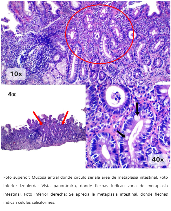 Metaplasia Intestinal