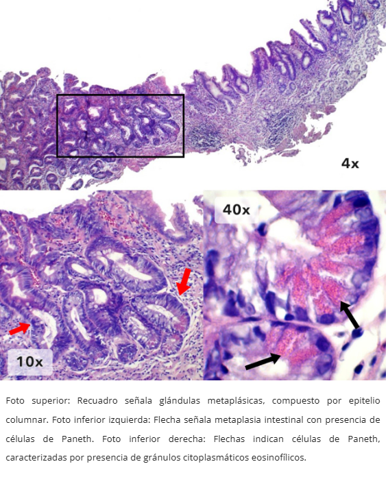 Metaplasia Intestinal
