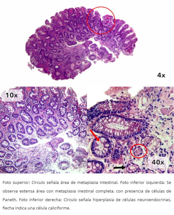 Metaplasia Intestinal