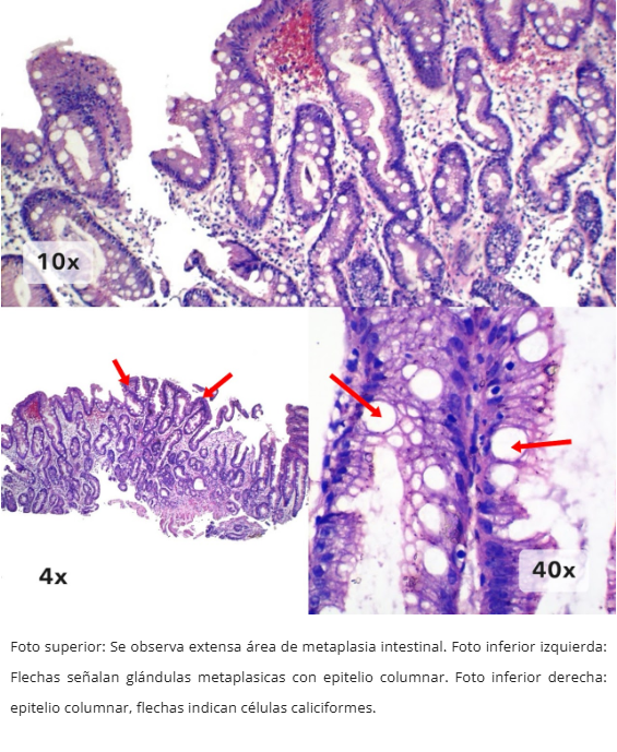 Metaplasia Intestinal