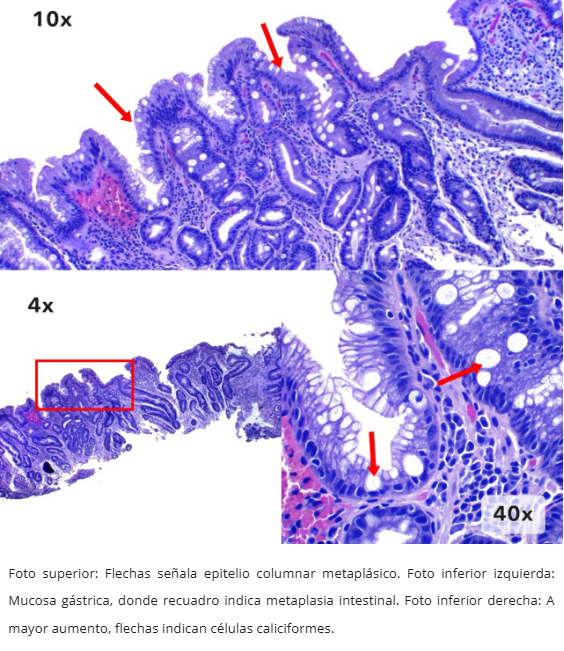 Metaplasia Intestinal