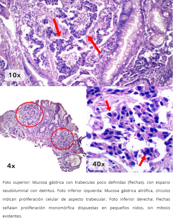 Neoplasia Neuroendocrina Gástrica