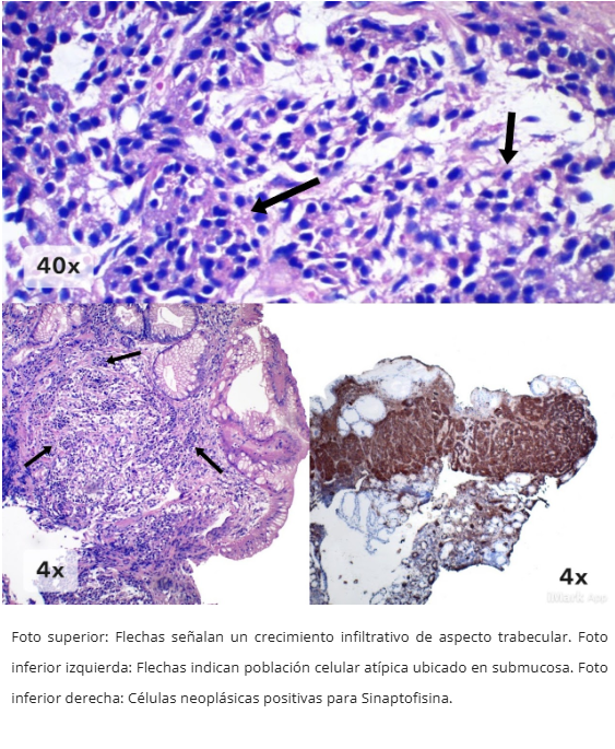 Neoplasia Neuroendocrina Gástrica