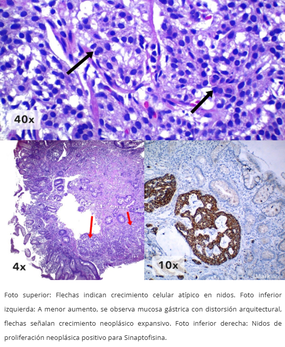Neoplasia Neuroendocrina Gástrica