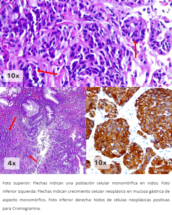 Neoplasia Neuroendocrina Gástrica