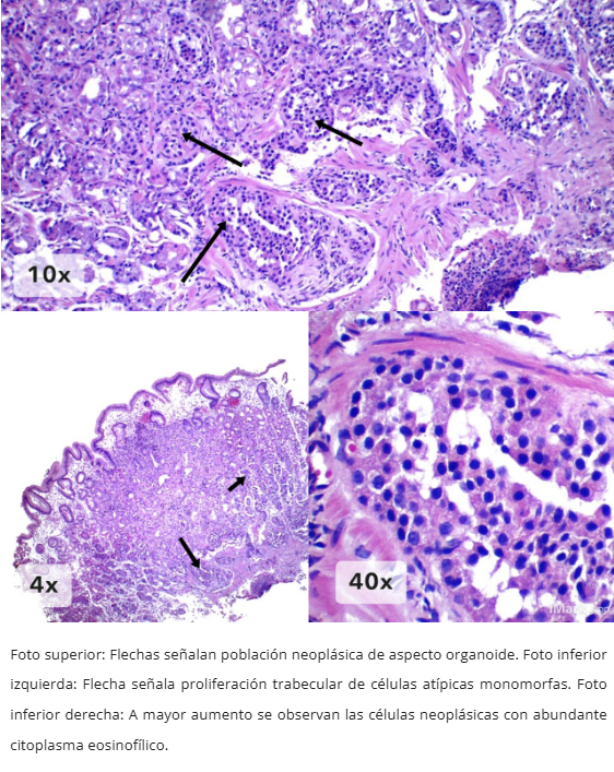 Neoplasia Neuroendocrina Gástrica