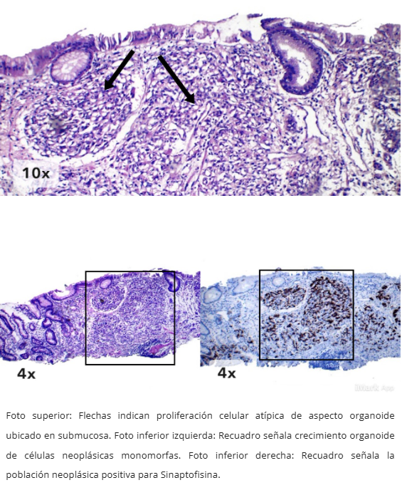 Neoplasia Neuroendocrina Gástrica