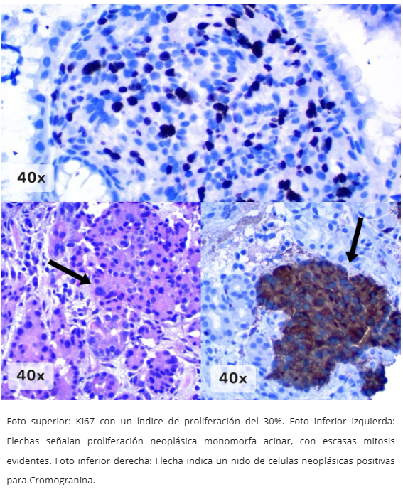Neoplasia Neuroendocrina Gástrica