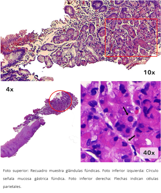 Mucosa Gástrica Heterotópica