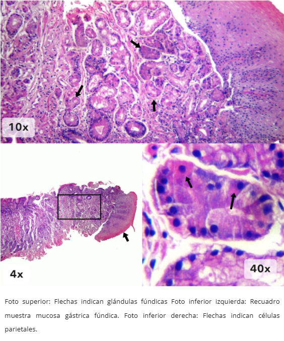 Mucosa Gástrica Heterotópica