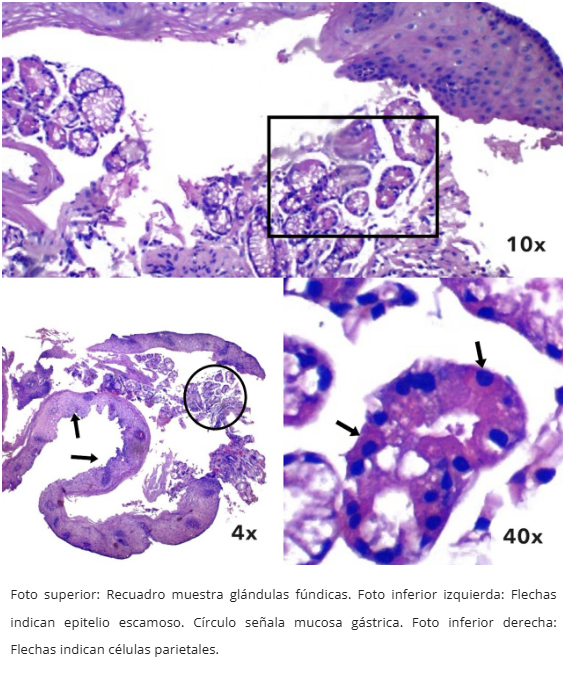 Mucosa Gástrica Heterotópica