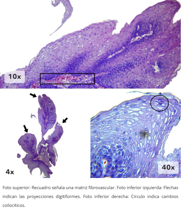 Papiloma Escamoso Esofágico