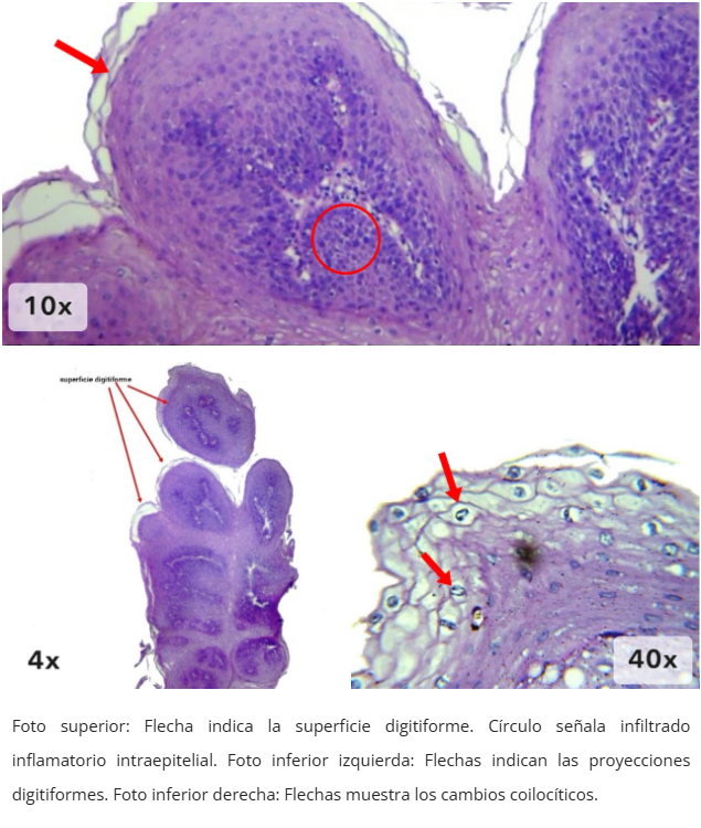 Papiloma Escamoso Esofágico