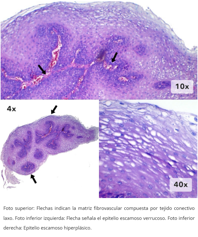 Papiloma Escamoso Esofágico
