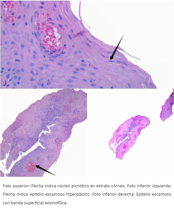 PARAQUERATOSIS ESOFAGICA DIFUSA