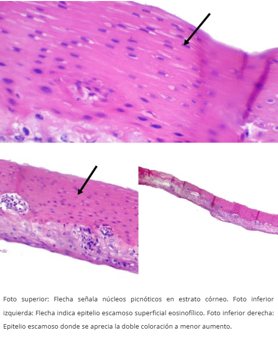 PARAQUERATOSIS ESOFAGICA DIFUSA
