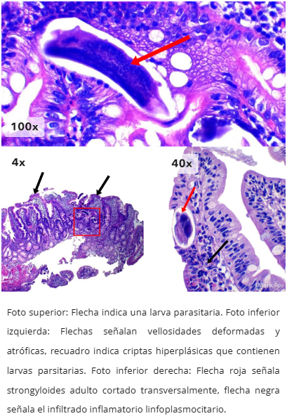 Estrongiloidiasis
