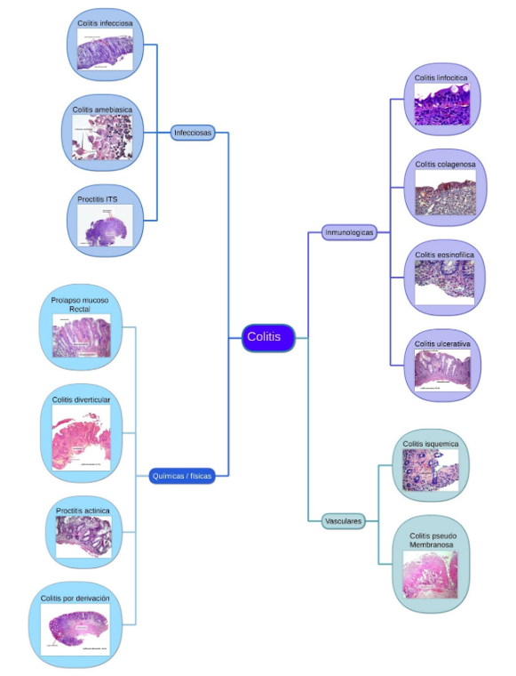Introducción a Colitis