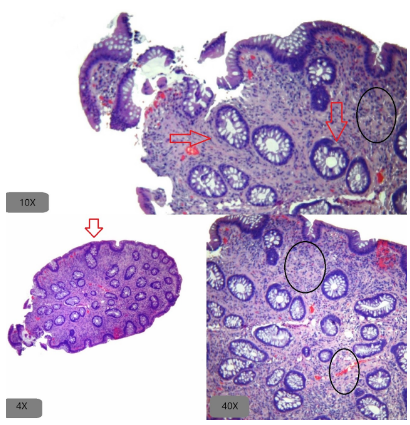 Endoscopía de pólipo inflamatorio