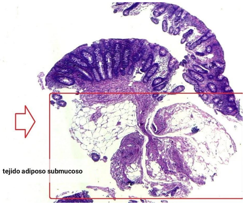 Lipoma de colon