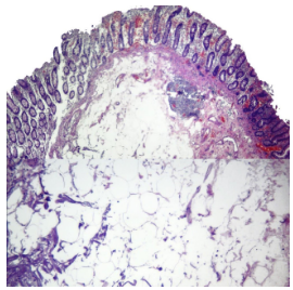 Lipoma de colon