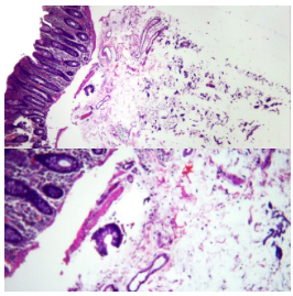 Lipoma de colon