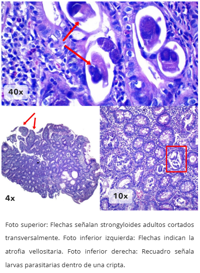 Microscopía Estrongiloidiasis