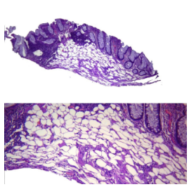 Lipoma de colon