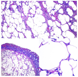 Lipoma de colon