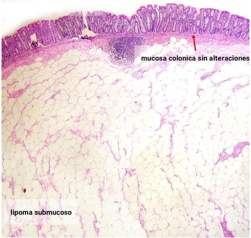 Lipoma de colon