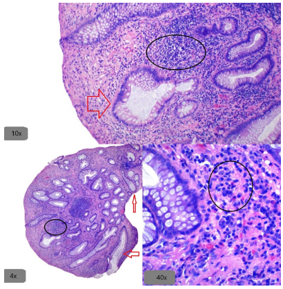 Eosinófilos numerosos