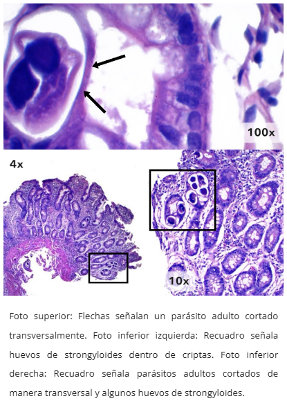 Hiperplasia glándulas