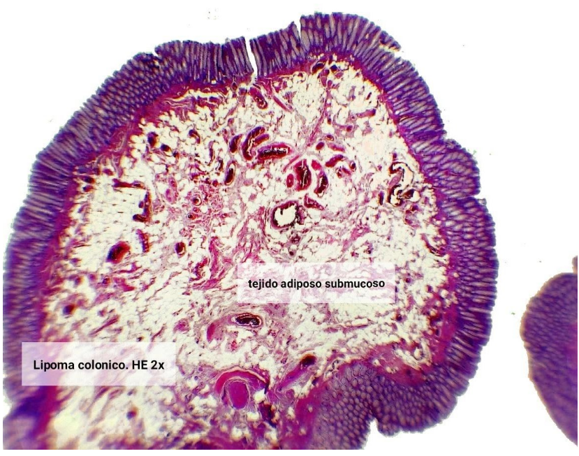 Lipoma de colon