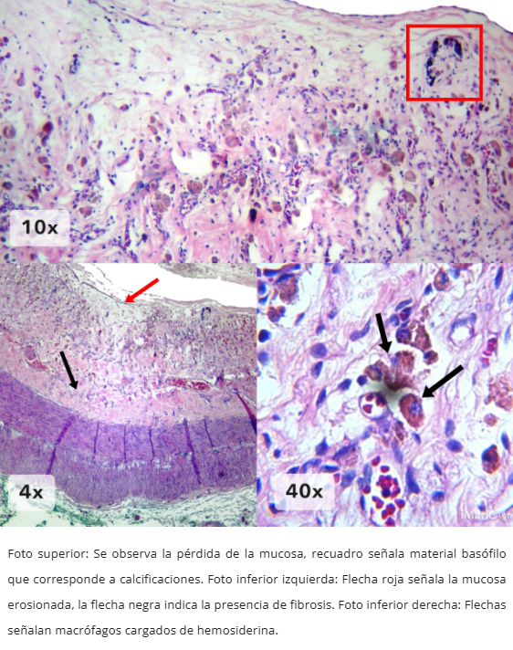 Atresia Intestinal