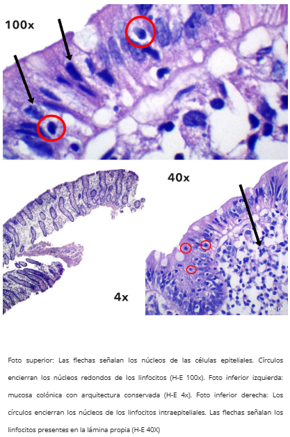 Colitis Linfocítica