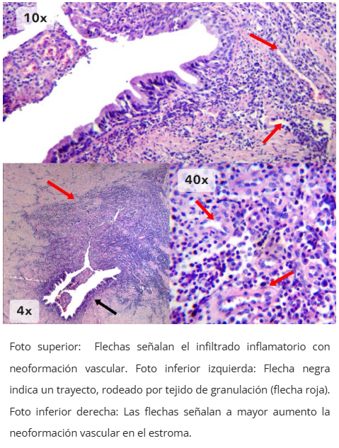 Imagen microscópica de trayecto fistuloso