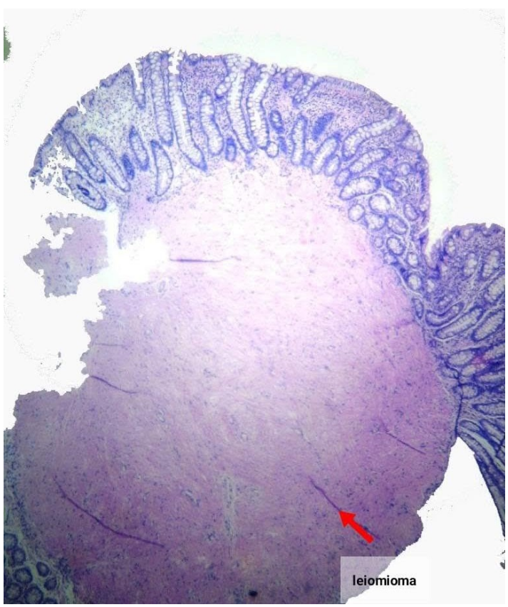 Leiomioma de colon