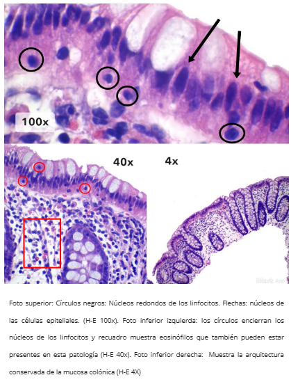 Infiltrado inflamatorio