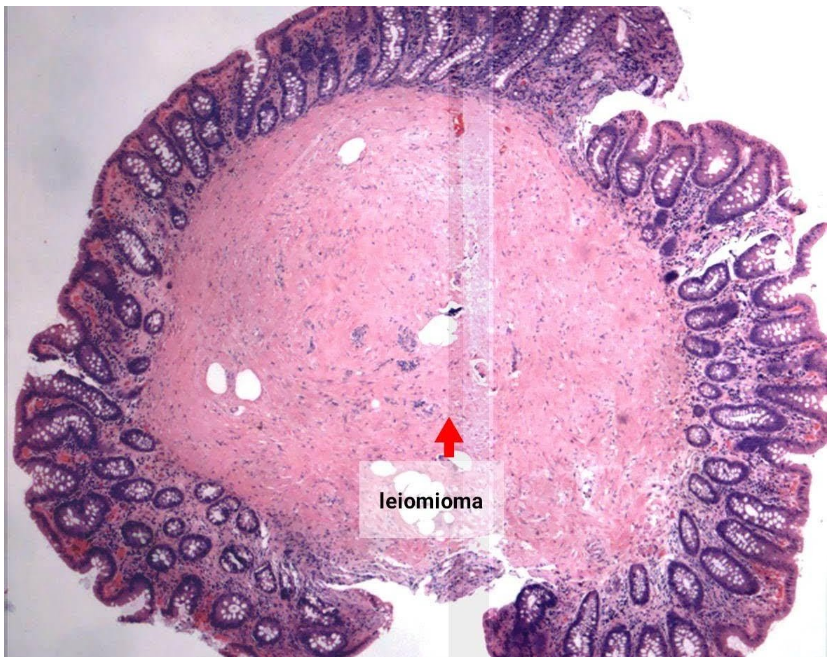 Leiomioma de colon