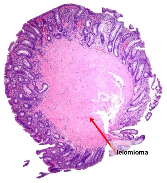 Leiomioma de colon
