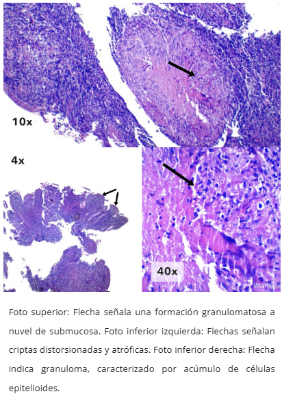 Tuberculosis intestinal