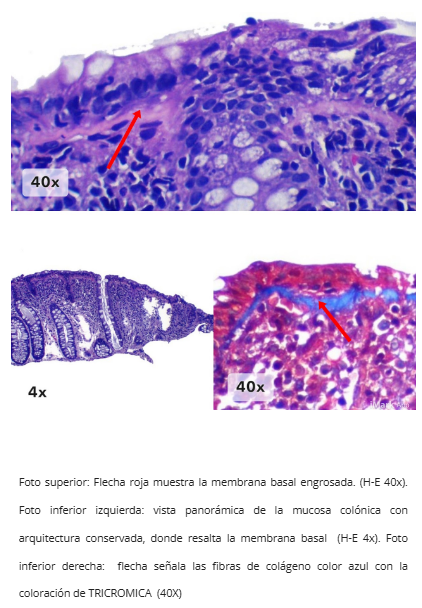 Colitis Colagenosa - Vista general