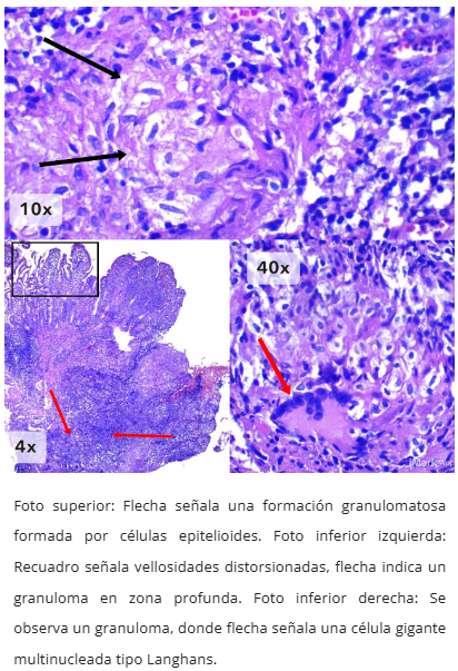 Granulomas tuberculosos