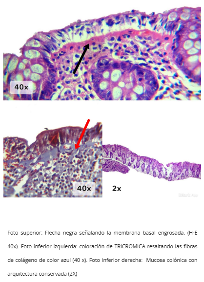 Engrosamiento membrana basal