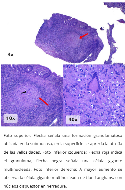 Microscopía TB intestinal