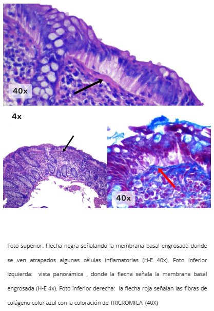 Infiltrado inflamatorio
