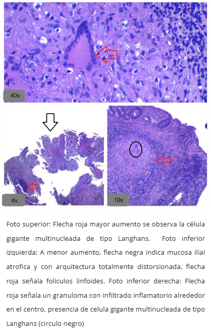 Inmunohistoquímica TB